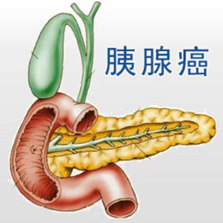 重慶御和堂老中醫講一講什麼人容易得胰腺癌?