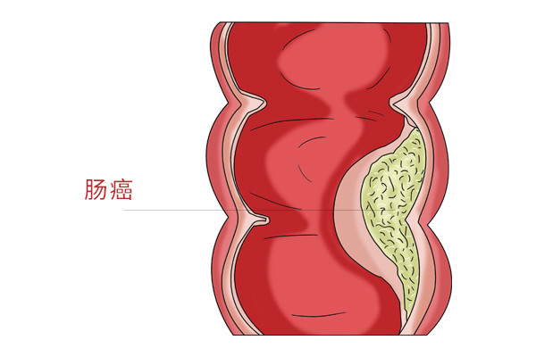 紅肉引起直腸癌的六種預防方法.